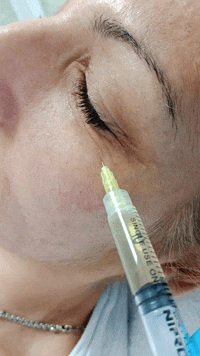 mezoterapija podočnjaka Kragujevac 