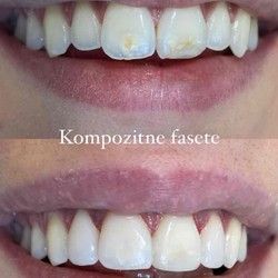 Kompozitne nonprep fasete