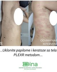 Uklanjanje papilona na telu