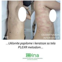 Uklanjanje papilona na telu