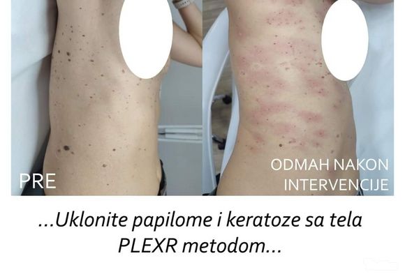 Uklanjanje papilona na telu