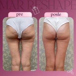 Efikasne metode za uklanjanje celulita