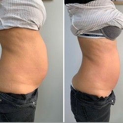 Kako se brzo rešiti viška vode u telu?