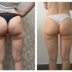 Koliko je anticelulit masaža potrebno za vidljive rezultate?