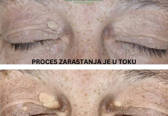 Skidanje masnih naslaga oko oka