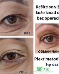 Resavanje spustenog kapka