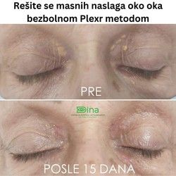 Uklanjanje masnih naslaga
