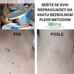 Uklanjanje papiloma