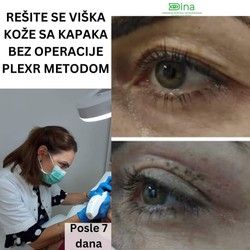 Sredjivanje kapaka