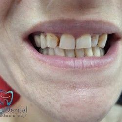 Bezmetalne cirkonijum krunice Čačak