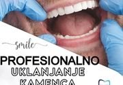 Uklanjanje zubnog kamenca Cacak