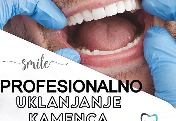 uklanjanje-zubnog-kamenca-cacak-298c77.jpg