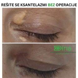Resite se masnih naslaga bez hirurhije