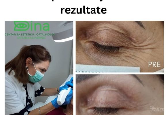 Uklanjanje viška kože bez operacije