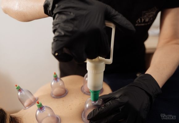 Cupping terapija vakumom