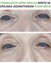 Podmlađivanje regije oko oka