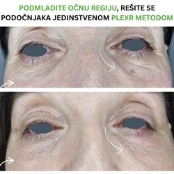 Podmlađivanje regije oko oka