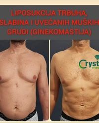 Liposukcija stomaka 