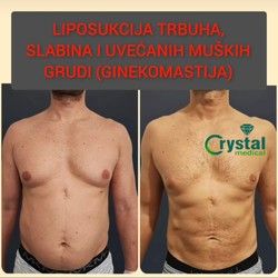 Liposukcija stomaka 