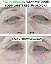 Nehiruško uklanjanje viška kože oko očiju