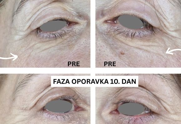 Nehiruško uklanjanje viška kože oko očiju