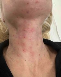 Biorevitalizacija vrata skin boosterom Zvezdara