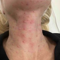 Biorevitalizacija vrata skin boosterom Zvezdara