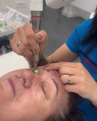 Podizanje kapaka Zvezdara 