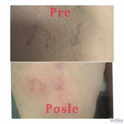 Uklanjanje proširenih kapilara Zvezdara