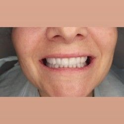 kompletna restauracija