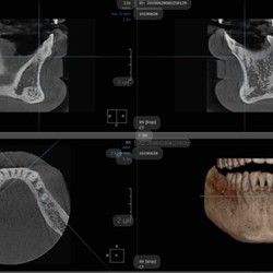 3D Snimanje zuba Grocka