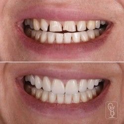 Razmak između zuba Novi Sad