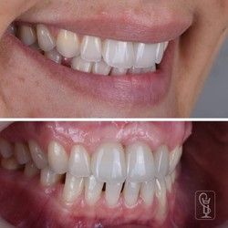 Bezmetalna krunica Novi Sad