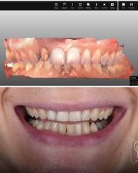 Sređivanje zuba Novi Sad