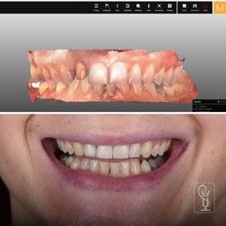 Sređivanje zuba Novi Sad