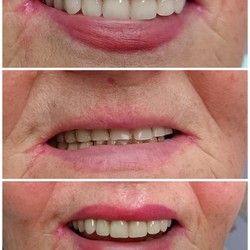 Totalne zubne proteze