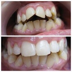 Fiksna proteza na delu... pre i posle