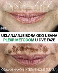 Uklanjanje bora iznad usana