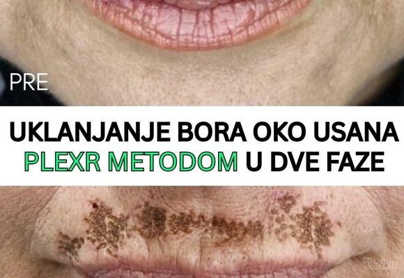 Uklanjanje bora iznad usana