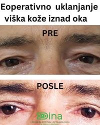 Podmlađivanje lica bez operacije
