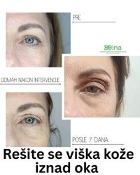 Bezbolno uklanjanje viška kože