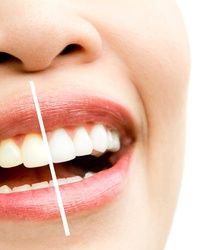 Izbeljivanje zuba Novi Sad – Profesionalno i bezbedno u ordinaciji Smile Concept po ceni od 18.000 RSD