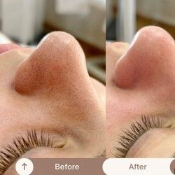 Higijenski tretman lica Novi Sad