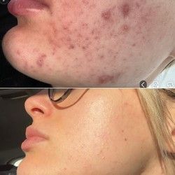 Lečenje akni Novi Sad