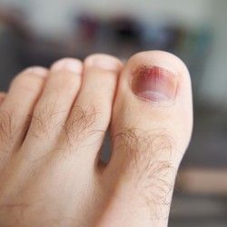 Vraćanje otpao ili povređenog nokta