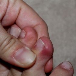 Lečenje uraslog nokta na nozi