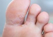 Lečenje atletskog stopala (tinea pedis)