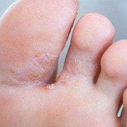 Lečenje atletskog stopala (tinea pedis)
