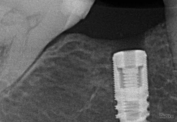 implantologija-1-407d09.jpg