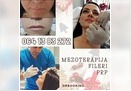 Mezoterapija, fileri, PRP